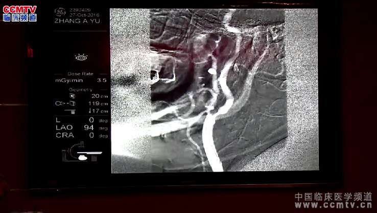 万杰清：双侧颈内动脉狭窄评估与支架植入手术