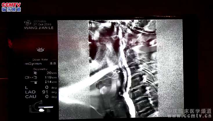 万杰清：左侧颈内动脉起始部狭窄支架植入术