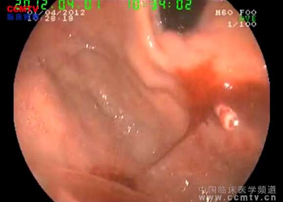 付唆林：胃Dieulafoy病 - 钛夹止血