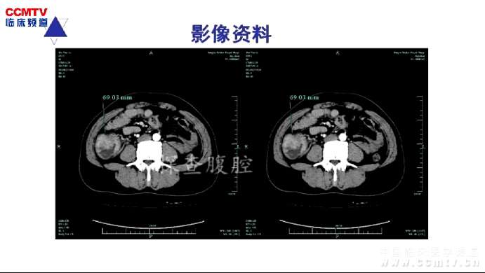 刘卫怀：腹腔镜右半结肠癌根治术