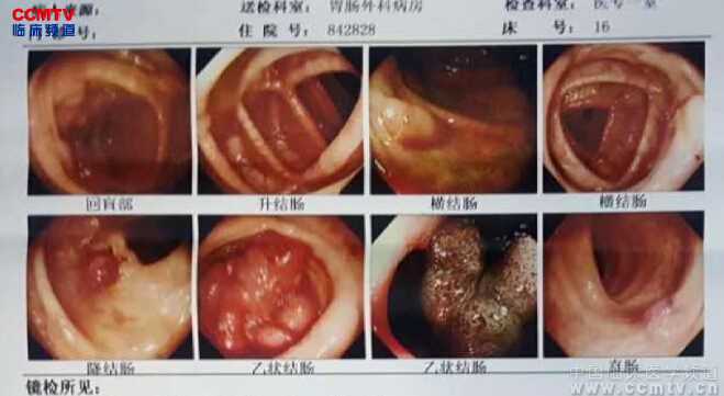 刘明发：结肠管状腺癌腹腔镜结肠次全切除术