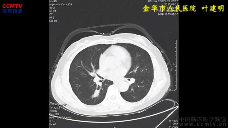 叶建明：肺癌微创手术治疗-单孔胸腔镜下右肺下叶切除+淋巴结清扫术