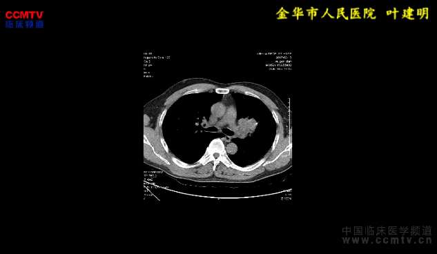 叶建明：胸腔镜下左全肺切除+淋巴结清扫