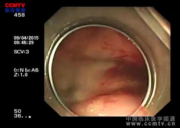 吴加国：胃间质瘤切除 + 创面缝闭技术OTSC