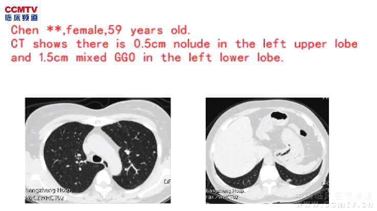 唐华：左下肺磨玻璃样结节 - 单孔左下叶切除术