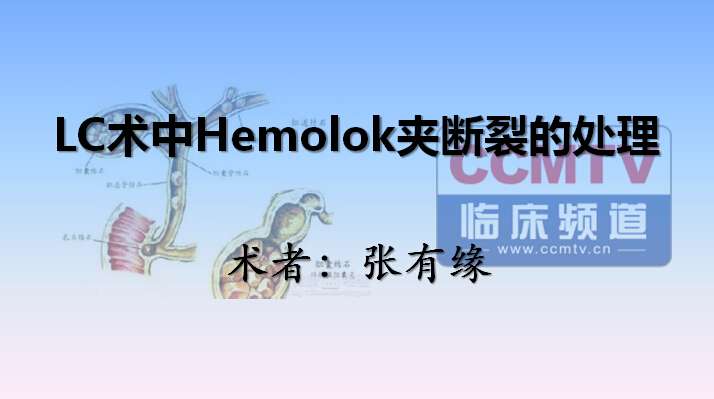 张有缘：LC术中Hemolok夹断裂的处理