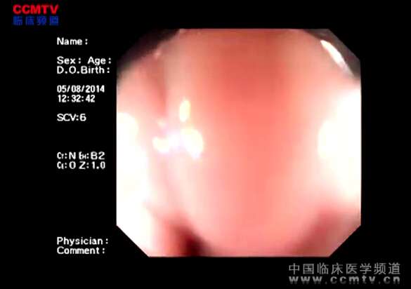 张烁：内镜下贲门黏膜剥离术