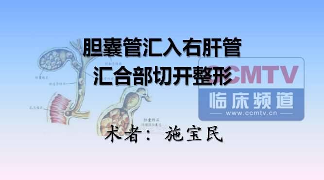 施宝民：胆囊管汇入右肝管+汇合部切开整形