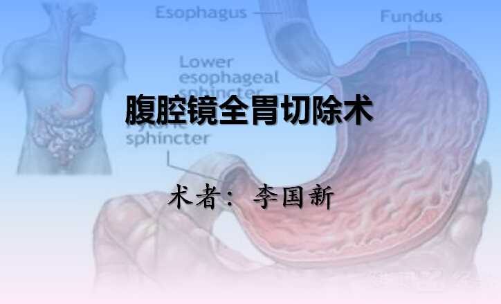 李国新：腹腔镜全胃切除术