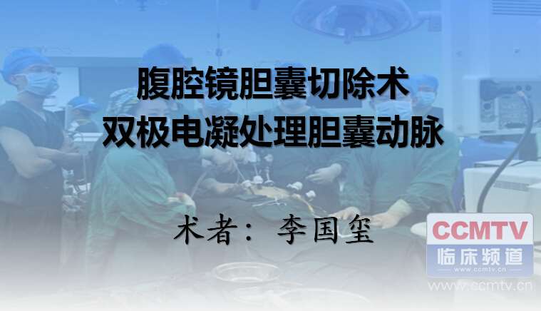 李国玺：腹腔镜胆囊切除术，双极电凝处理胆囊动脉