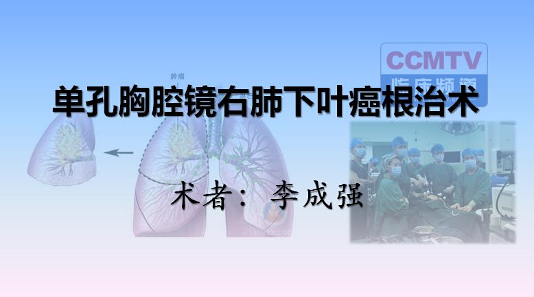 李成强：单孔胸腔镜右肺下叶癌根治术