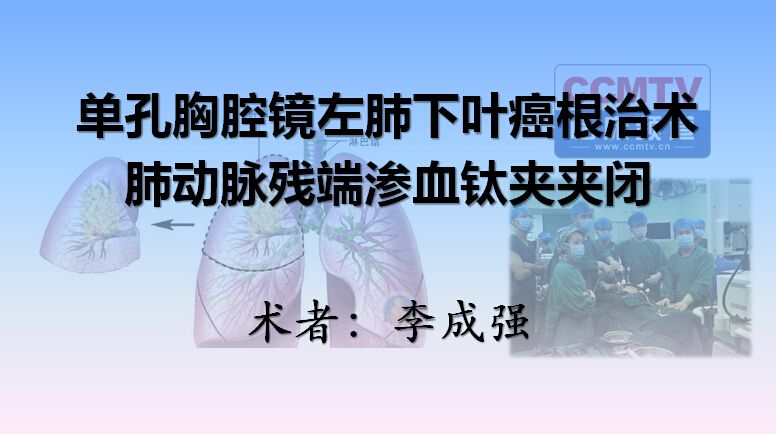 李成强：单孔胸腔镜左肺下叶癌根治术，肺动脉残端渗血钛夹夹闭