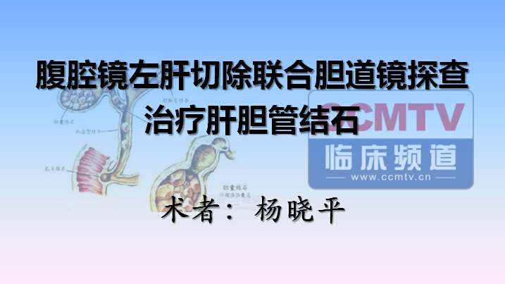 杨晓平：腹腔镜左肝切除联合胆道镜探查治疗肝胆管结石