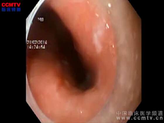 欧阳淼：食道高级别癌变的内镜下粘膜剥离术（ESD）