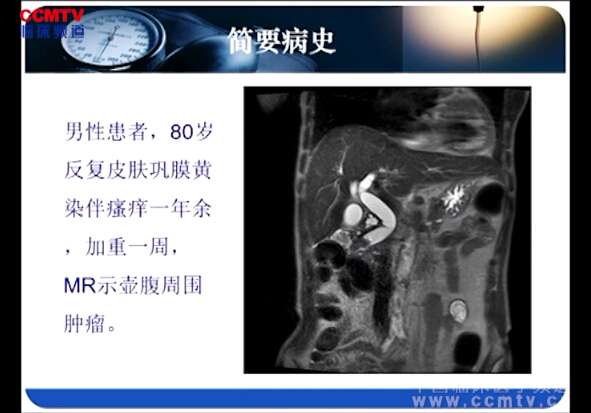 王红玲：十二指肠乳头癌再次金属支架置入术