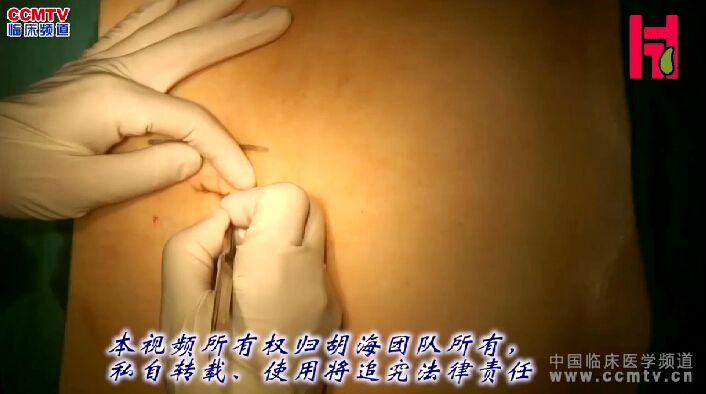 胡海：剑脐腹腔镜胆囊切除术