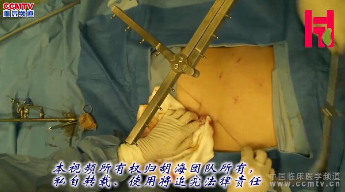 胡海：老年女性，悬吊免气腹装置单孔腹腔镜胆囊切除术