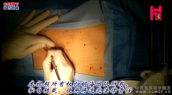 胡海：胆囊腺肌症，经脐单孔腹腔镜胆囊切除术