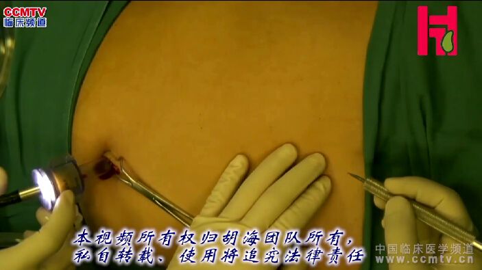 胡海：针孔器械腹腔镜保胆取石术