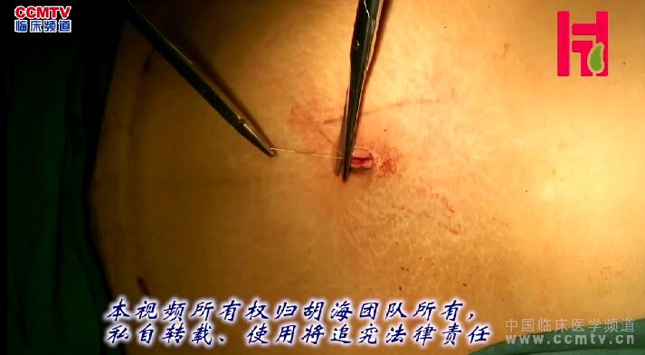 胡海：隐瘢痕腹腔镜胆囊切除术（经原手术瘢痕）