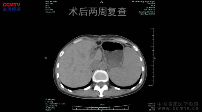 詹志林：腹腔镜解剖性左肝外叶切除治疗左肝外叶巨大血管瘤