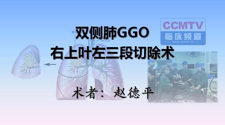 赵德平：双侧肺GGO右上叶左三段切除术（含讲解，英语）