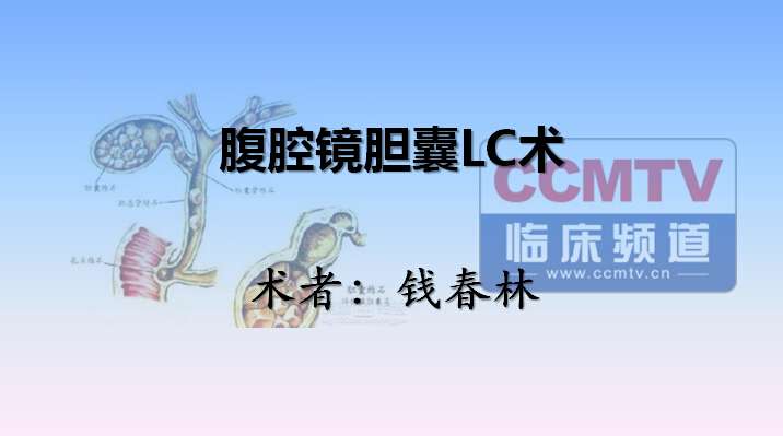 钱春林：腹腔镜胆囊LC术