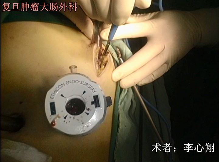 腹腔镜结肠手术